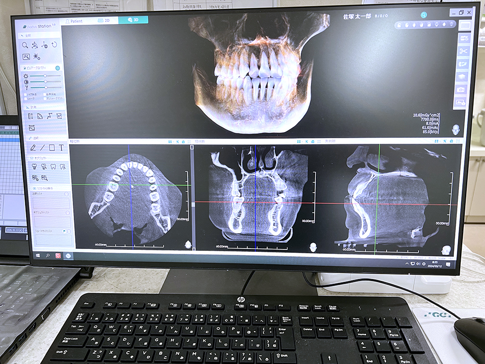 歯科用CT撮影データ