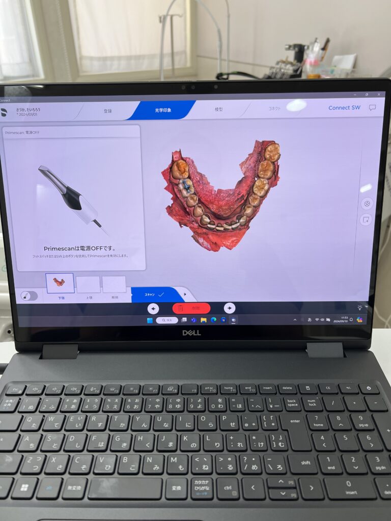 パソコンに写った下顎のスキャン画像