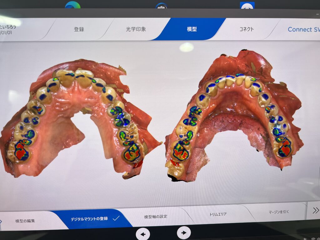 上顎と下顎のかみ合わせで強く当たっているところの画像